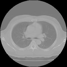 CT画像の縦隔条件表示モード